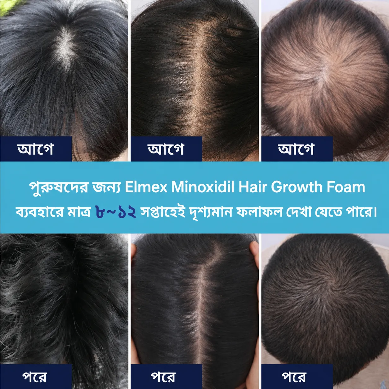 Why Minoxidil Spray Routine